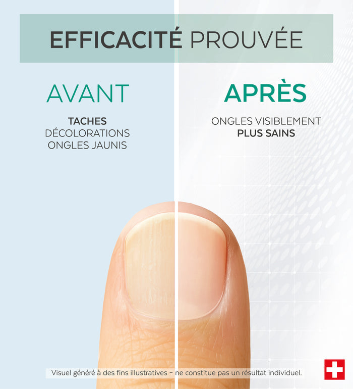 Efficacité prouvée avant après du sérum concentré tea tree Poderm