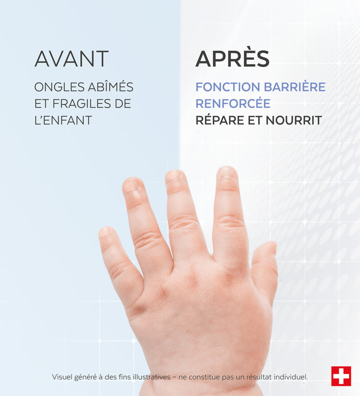 Résultats avant-après du sérum ongles abîmés Kids Poderm efficacité prouvée