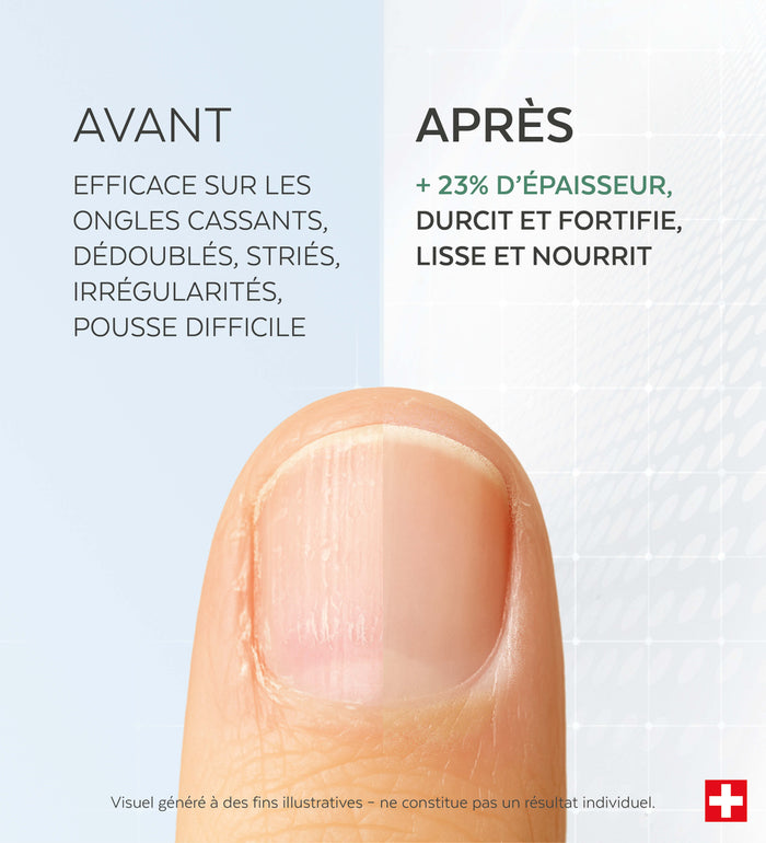 Résultats avant-après du sérum ongles cassants striés Poderm efficacité prouvée