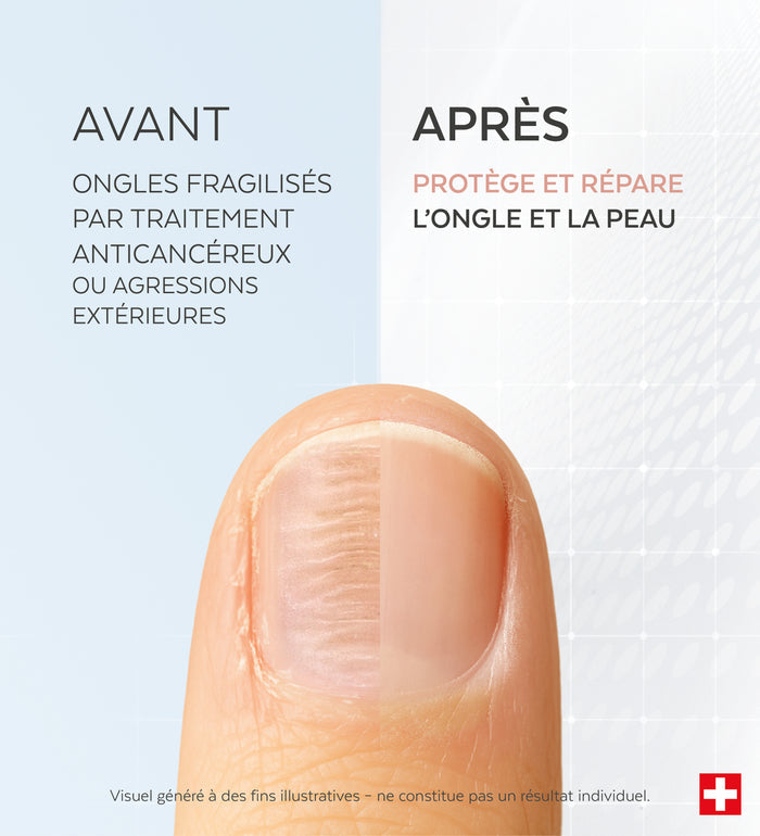 Résultats avant-après du sérum ongles fragilisés silicium Poderm efficacité prouvée