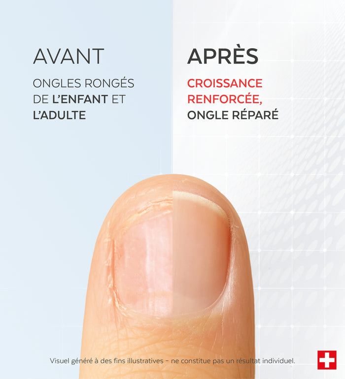 Résultats avant-après du sérum ongles rongés Poderm efficacité prouvée