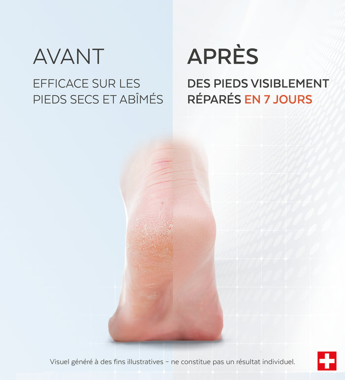 Résultats avant-après du sérum pieds très secs et abîmés Poderm