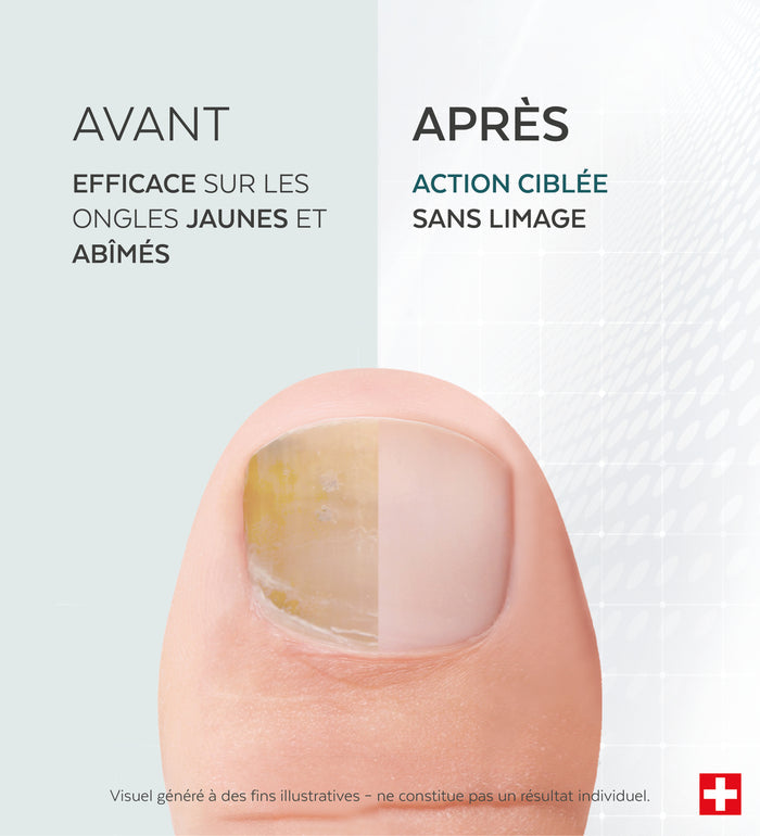 Technologie brevetée du sérum réparateur tea tree ongles Poderm 100% naturel