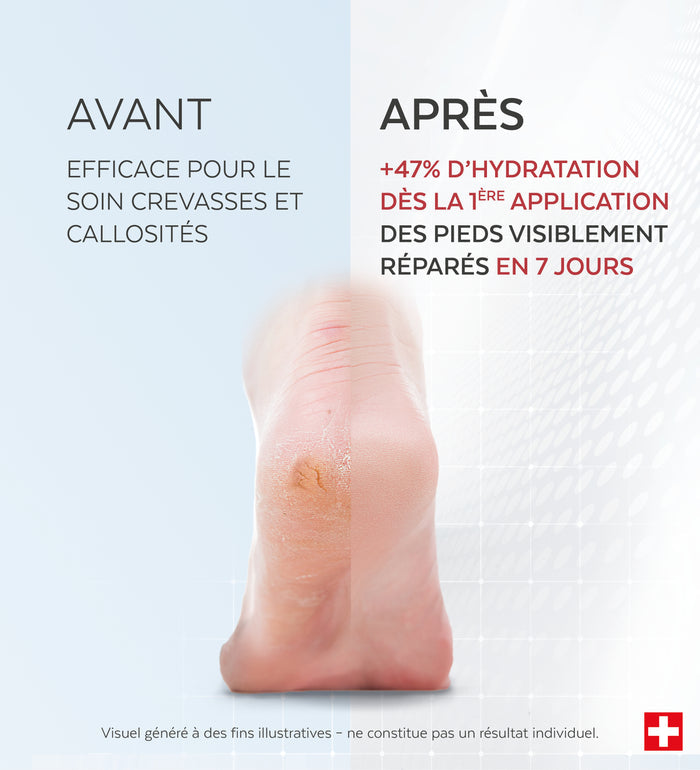 Résultats avant-après du sérum crevasses et callosités Poderm