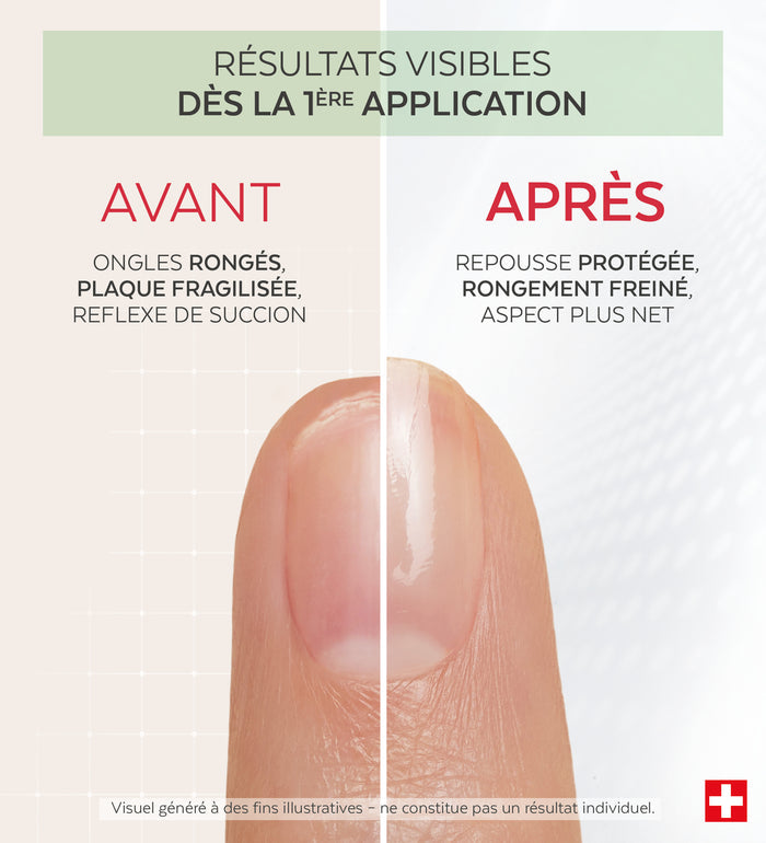 Résultats avant après du vernis Nail Corrector amer protéines de pois Poderm dès la 1ère application